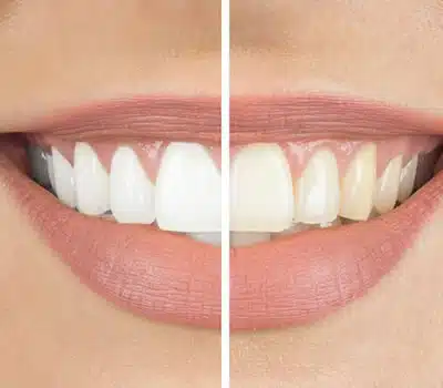 Pastas de Dente Clareadora