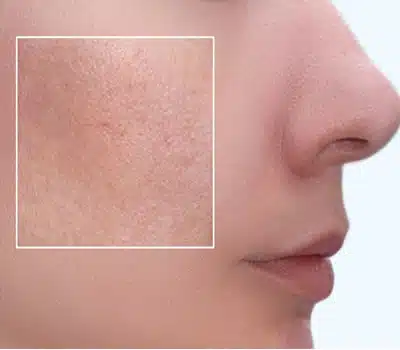 Demaquilantes para Cada Tipo de Pele